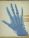 x-ray of a hand