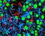 Brain Damage Triggered by Mini-Strokes Detailed Brain Damage Triggered by Mini-Strokes Detailed
