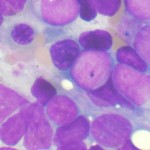 Cancer Cell Metabolism Yields New Insights on Leukemia Cancer Cell Metabolism Yields New Insights on Leukemia