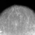 New Law Impacts Mammogram Providers New Law Impacts Mammogram Providers