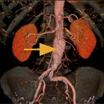 New Device Developed to Treat Aneurysms New Device Developed to Treat Aneurysms