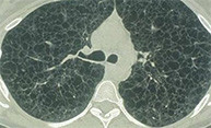 New Clinic Researches Rare Lung Disease New Clinic Researches Rare Lung Disease