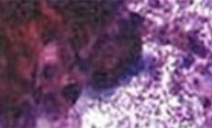 Fighting Esophageal Cancer with WATS Fighting Esophageal Cancer with WATS