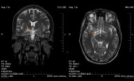 Genetic Signature of a Brain Cancer ID’d Genetic Signature of a Brain Cancer ID’d