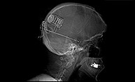New Brain Device Counteracts Epileptic Seizures New Brain Device Counteracts Epileptic Seizures