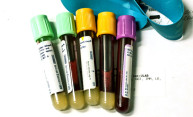 Blood test predicts Alzheimer’s risk Blood test predicts Alzheimer’s risk