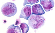 Congenital herpes tied to lower developmental test scores in infants Congenital herpes tied to lower developmental test scores in infants