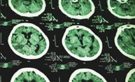 Drug shows promise in slowing multiple sclerosis Drug shows promise in slowing multiple sclerosis