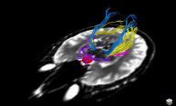 New imaging technique helps predict how vision recovers after brain tumor removal New imaging technique helps predict how vision recovers after brain tumor removal