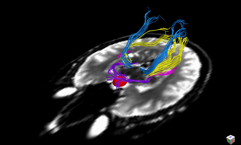 New imaging technique helps predict how vision recovers after brain