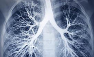 Treatment for fatal lung disease shows promise Treatment for fatal lung disease shows promise