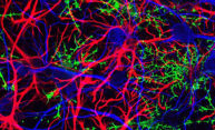 Swapping sick for healthy brain cells slows Huntington’s disease Swapping sick for healthy brain cells slows Huntington’s disease