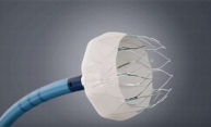 Device reduces stroke risk for patients with atrial fibrillation Device reduces stroke risk for patients with atrial fibrillation
