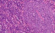 As leukemia evolves, stem cells hold keys to newer therapies As leukemia evolves, stem cells hold keys to newer therapies