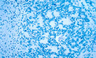 Nuclear protein causes cancer to become more aggressive Nuclear protein causes cancer to become more aggressive