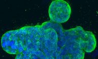 Making radiotherapy better for cancer patients Making radiotherapy better for cancer patients