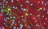 Research to explore new therapies for Huntington’s disease Research to explore new therapies for Huntington’s disease