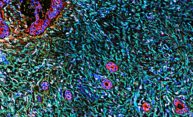 Pancreatic tumors may require a one-two-three punch Pancreatic tumors may require a one-two-three punch