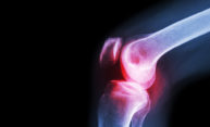 Weight might not be why obesity damages knees Weight might not be why obesity damages knees