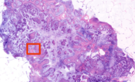 Novel imaging system could mean near-instant biopsy results Novel imaging system could mean near-instant biopsy results