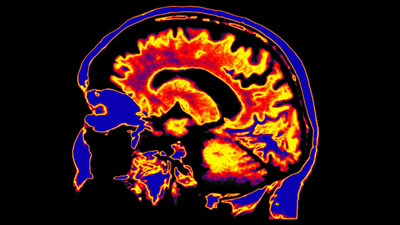 An image of a brain highlighting different regions in bright red, yellow, orange, and blue.