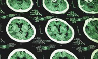 Blows to head damage brain’s ‘garbage truck,’ accelerate dementia
