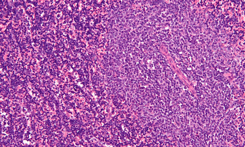 Leukemia cells