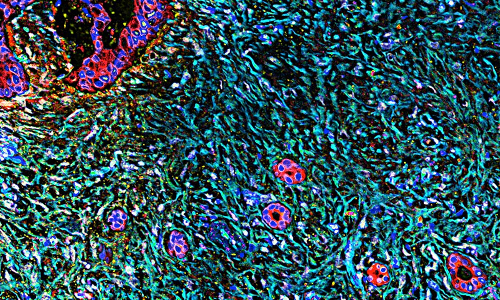 pancreatic cancer cells in cancer tumor