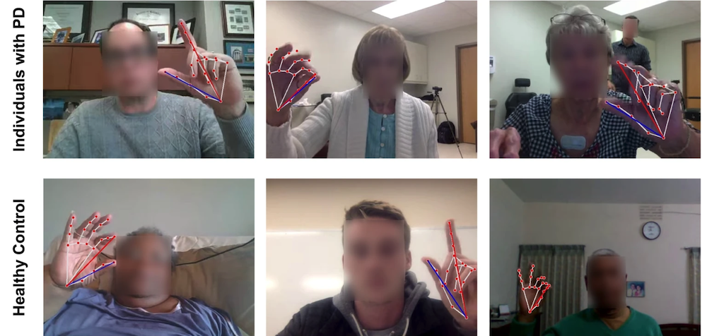 Grid of hand gesture images from three people with Parkinson's and three people without the disease to illustrate a test for Parkinson's disease.