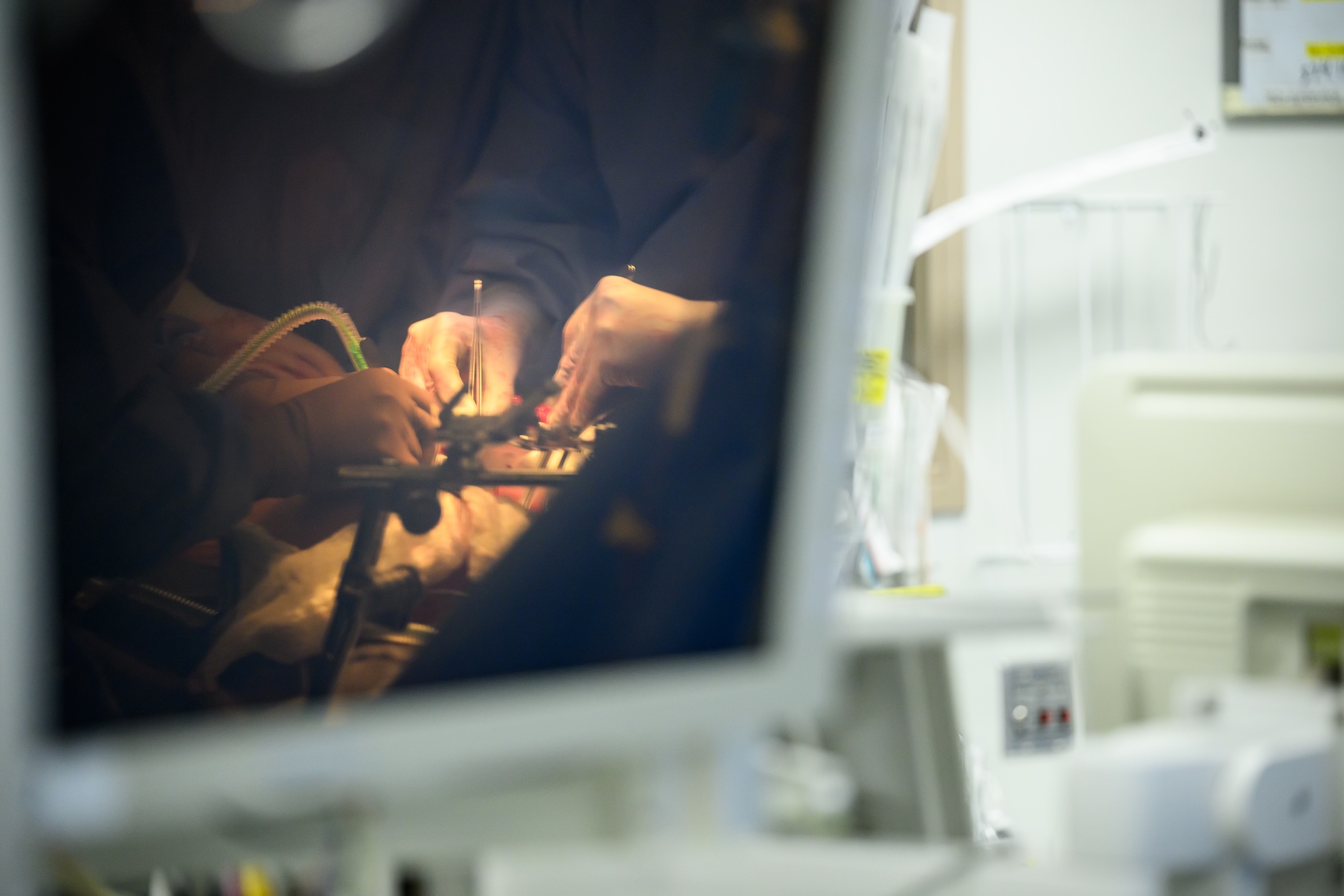 A monitor displays surgeons’ hands performing a delicate procedure, with medical equipment blurred in the foreground.